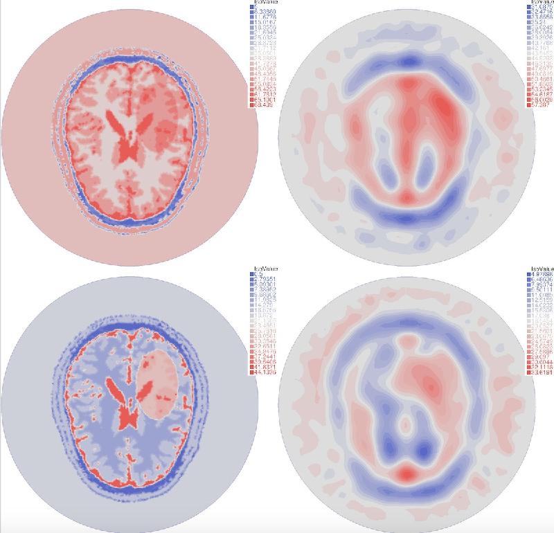Map of permittivity in the brain obtained from MRI images (high) vs. reconstructed permittivity (low)